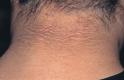 Acanthosis nigricans