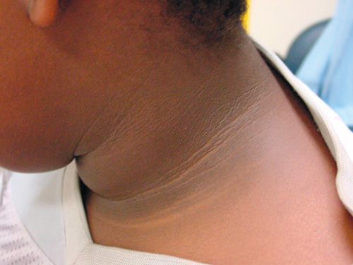 Acanthosis nigricans