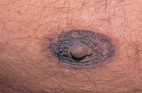 Acanthosis nigricans