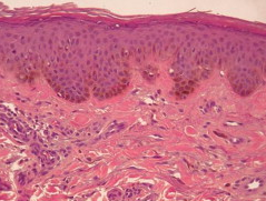 Acquired bilateral nevus of Ota-like macules