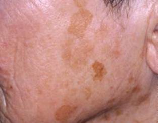 Acquired bilateral nevus of Ota-like macules