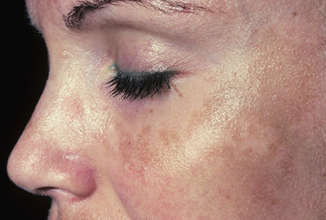 Acquired bilateral nevus of Ota-like macules Acquired bilateral nevus of Ota-like macules