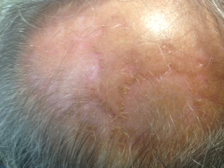 Actinic granuloma