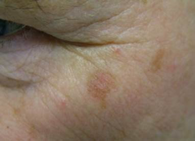 actinic keratoses