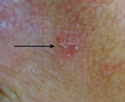 actinic keratoses