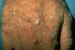 actinic keratoses