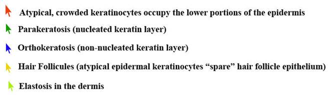actinic keratoses