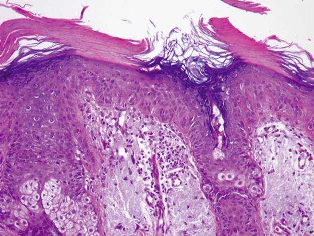 actinic keratoses