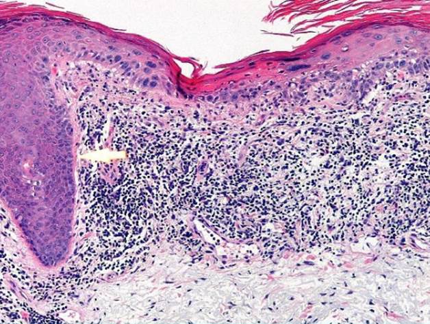 actinic keratoses