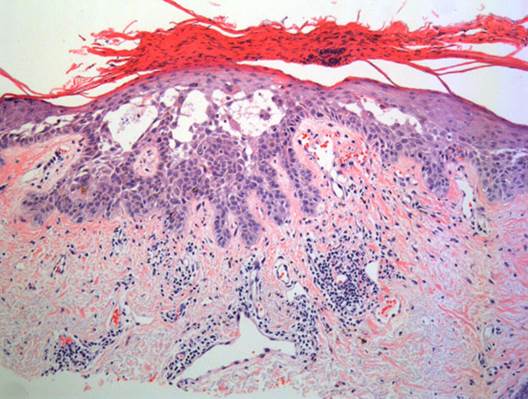 actinic keratoses