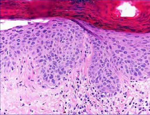 actinic keratoses