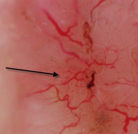 actinic keratinosis