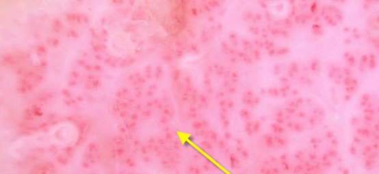 actinic keratinosis