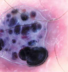 eritema ab igne Angiokeratomas