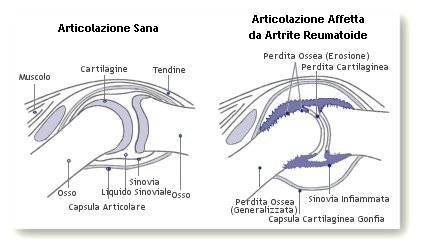 artrite reumatoide