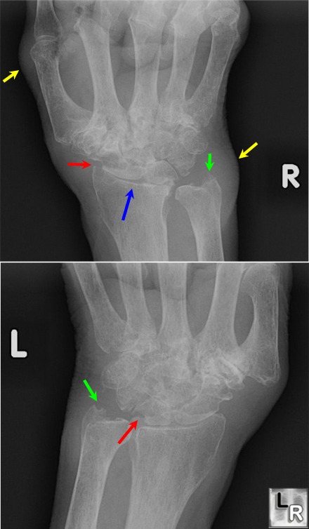 Immagine di una radiografia artrite reumatoide