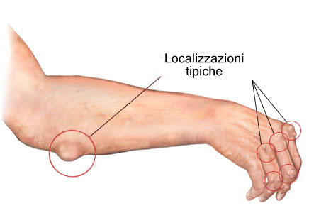 Zone tipiche dove si localizzano le irritazioni artrite reumatoide