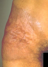 granulomatous slack skin artrite reumatoide