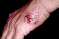 Forma atipica di Pioderma gangrenoso Pioderma gangrenoso