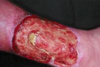 Forma classica di Pioderma gangrenoso Pioderma gangrenoso