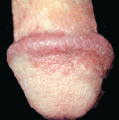 balanitis