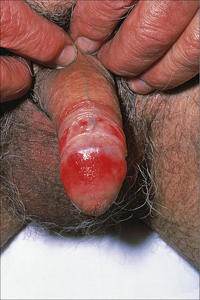 balanitis