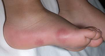 Chilblains