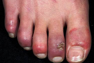 Chilblains