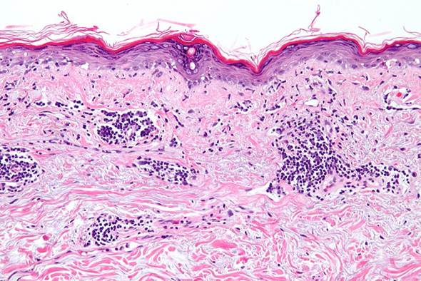 Chilblains