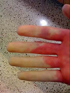 Raynaud's phenomenon