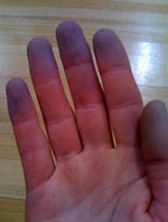 Raynaud's phenomenon