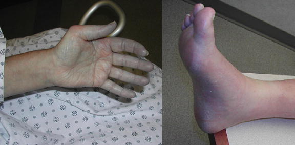 Acrocyanosis