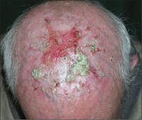 Erosive dermatosis