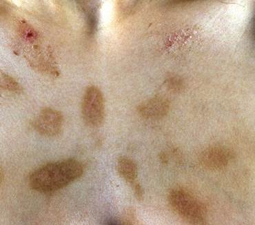 Dermatosis negletta