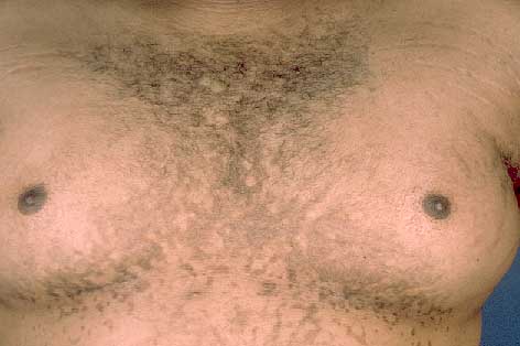 Dermatosis negletta