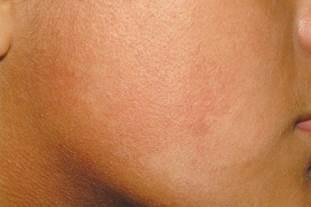 Image of EFF on the cheek and neck EFF on the cheek and neck