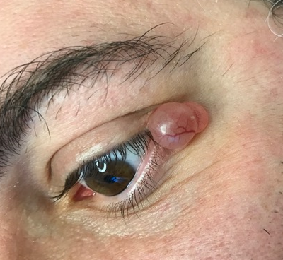 Idrocistoma Eccrino Idrocistoma Eccrino