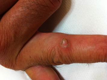 Acquired digital fibrokeratoma Acquired digital fibrokeratoma