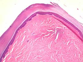 Acquired digital fibrokeratoma