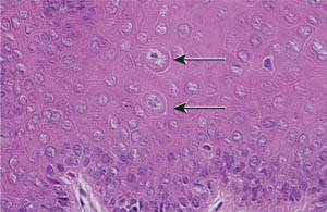 Focal epithelial hyperplasia