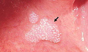 Focal epithelial hyperplasia