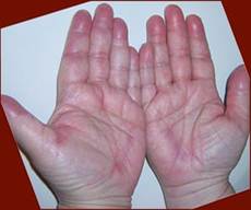 hand foot syndrome
