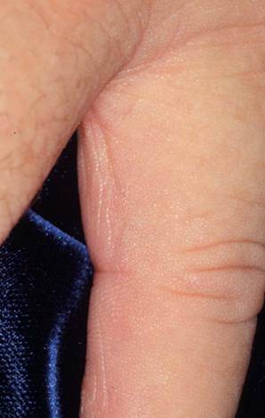 Huntley’s papules