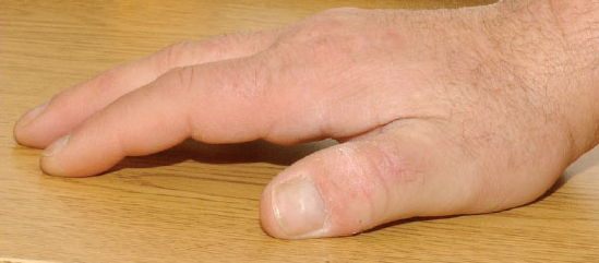Sindrome della mano diabetica Sindrome della mano diabetica