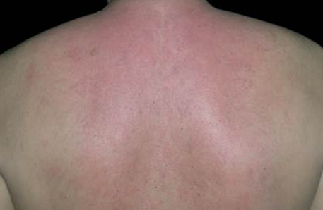 Scleredema dei diabetici o scleroedema diutinum Scleredema dei diabetici o scleroedema diutinum