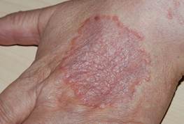 granuloma anulare granuloma anulare