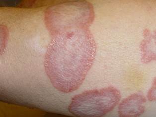 granuloma anulare granuloma anulare