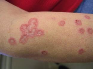 granuloma anulare granuloma anulare