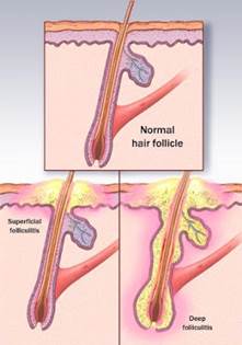 Follicoliti Follicoliti