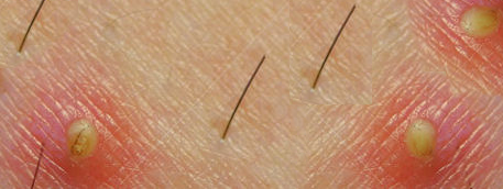 Follicoliti Follicoliti